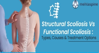 Structural Scoliosis Vs Functional Scoliosis