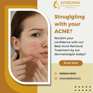 Struggling with your Acne | Best Skin Clinic in Jayanagar | Epiderma Clinic