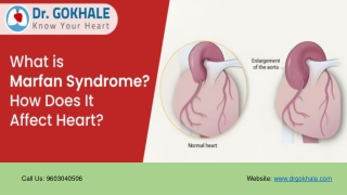What Is Marfan Syndrome? How Does It Affect Heart? | Dr Gokhale