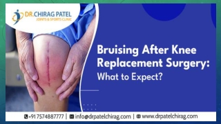 How To Reduce Bruising After Knee Replacement Surgery