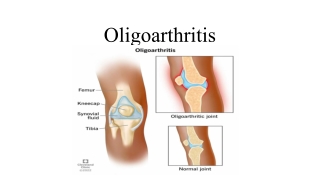 Oligoarthritis (1)