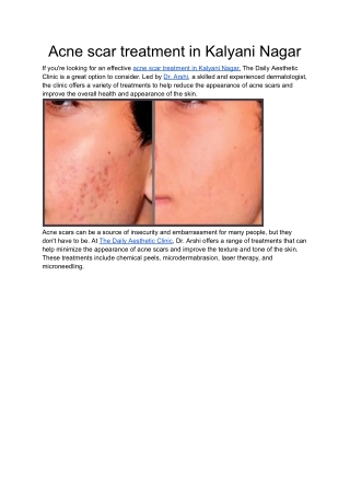 Acne scar treatment in Kalyani Nagar