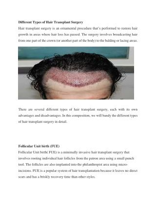 Different Types of Hair Transplant Surgery