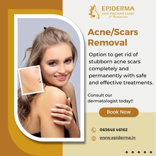 Acne or Scars Removal | Skin Clinic in Jayanagar, Bangalore | Epiderma Clinic