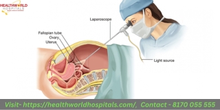 After a Laparoscopic Sleeve Resection Surgery Nutritional Dos and Don'ts  HealthWorldHospitals