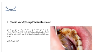 إزالة جير الأسنان | /KeepTheSmile.me/ar