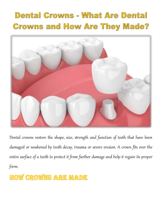 Dental Crowns - What Are Dental Crowns and How Are They Made