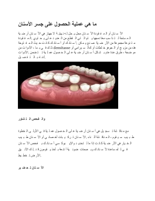 ما هي عملية الحصول على جسر الأسنان