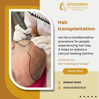 Hair Transplantation Procedure - Best Hair Clinic in Jayanagar - Epiderma Clinic