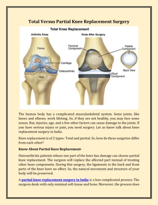 Total Versus Partial Knee Replacement Surgery