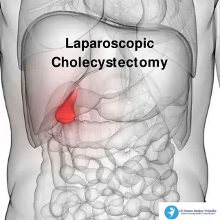 Laparoscopic Cholecystectomy,Treatment In HSR layout,BangaloreDr.Manas tripathy