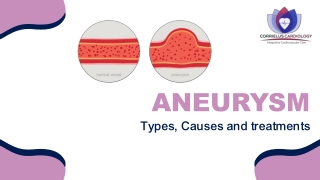 Aneurysm: Types, causes & treatment