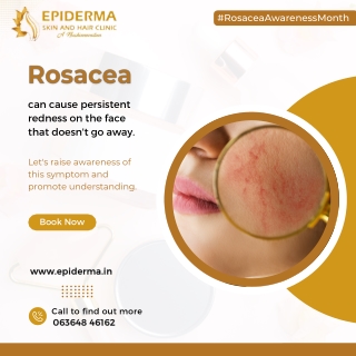 Rosacea Awareness Month | Best Dermatology Centre in Jayanagar | Epiderma Clinic