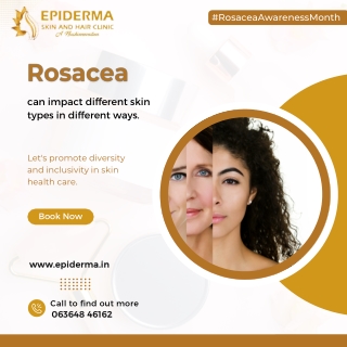 Which Types of Skin Are More Susceptible to Rosacea | Epiderma Clinic