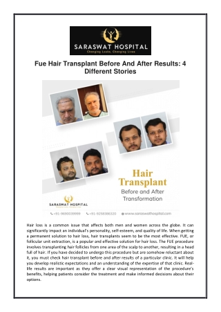 FUE Hair Transplant Before and After Results: 4 Different Stories