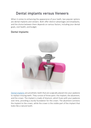 Dental implants versus Veneers
