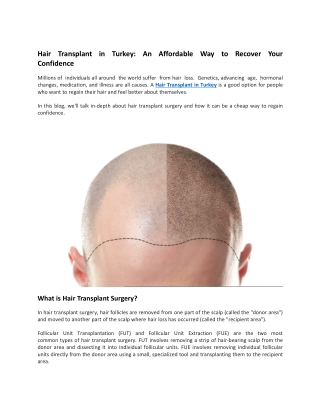 Hair Transplant in Turkey An Affordable Way to Recover Your Confidence