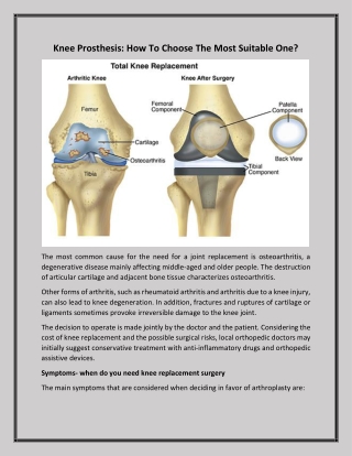 Knee Prosthesis: How To Choose The Most Suitable One?