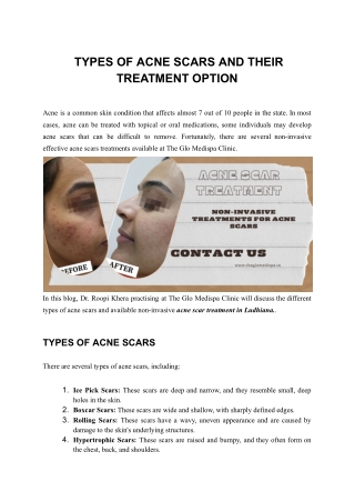 Types of Acne Scars and Their Treatment Option