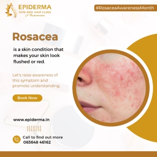 What is Rosacea | Best Skin Clinic in Jayanagar, Bangalore | Epiderma Clinic