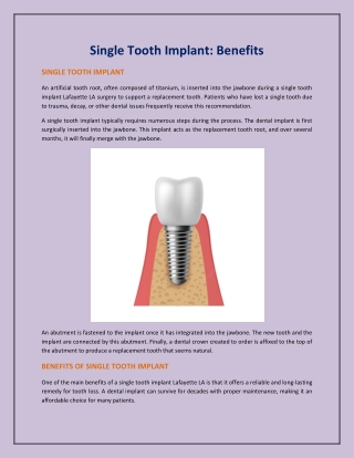 Single Tooth Implant: Benefits