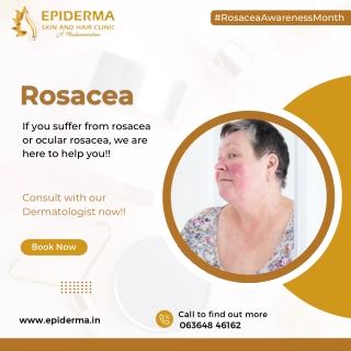 Suffering from Rosacea or Ocular Rosacea | Epiderma Skin and Hair Clinic