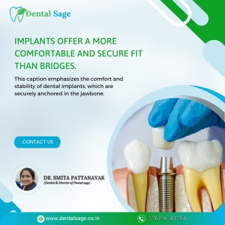 Dental Implants are more comfortable and secure | Dental Sage