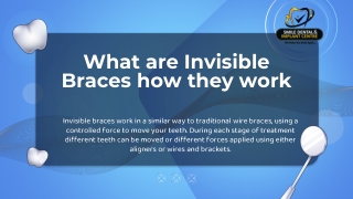 What are Invisible Braces How They Work | Smile Dental and Implant Centre