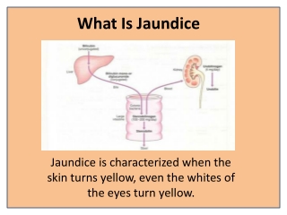 JAUNDICE RELIEF Potent Natural Herbal Remedy