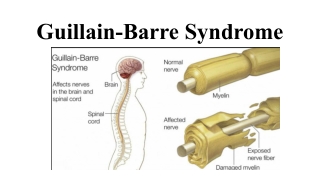 Guillain-Barre Syndrome