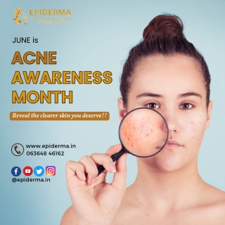 June is Acne Awareness Month | Epiderma Skin and Hair Clinic Jayanagar Bangalore