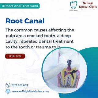 Know about Root Canal Causes | Best Dental Clinic in Bellandur | Nelivigi Dental