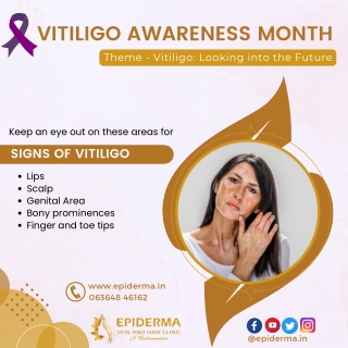 Know the Signs of Vitiligo | Epiderma Skin and Hair Clinic Jayanagar, Bangalore