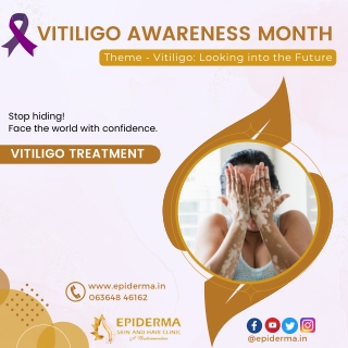 Get Embrace transformative treatments for Vitiligo - Epiderma Clinic