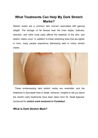 What Treatments Can Help My Dark Stretch Marks