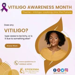 Does any Vitiligo type cease to be itchy | Epiderma Skin and Hair Clinic