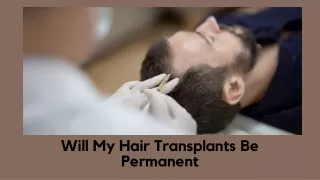 Will My Hair Transplants Be Permanent