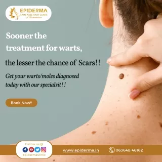 Treatment for warts | Best Skin Clinic in Jayanagar, Bangalore | Epiderma Clinic