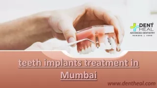 Teeth Implants Treatment in Mumbai | Dent Heal