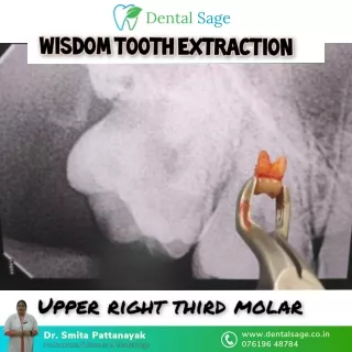 Wisdom Tooth Extraction (Upper right Third Molar) | Dental Sage