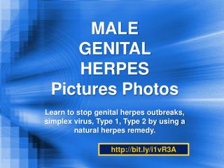male genital herpes remedy pictures photos