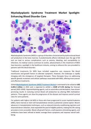 pdf Myelodysplastic Syndrome Treatment Market Spotlight