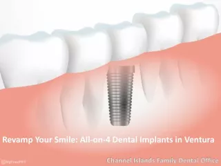 ALL ON 4 Dental Implants