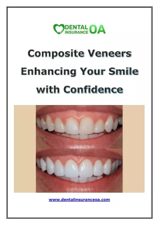 Discover About Composite Veneers: To Boost Your Smile With Confidence