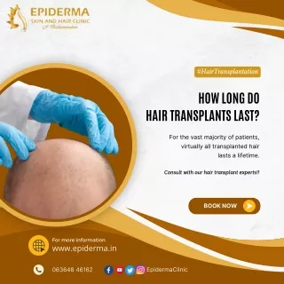 How Long Do Hair Transplants Last |Hair Clinic in Jayanagar | Epiderma Clinic