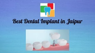 Best Dental Implant in Jaipur