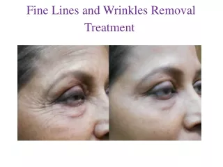 Wrinkles & Fine Lines Removal Treatment
