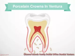 Porcelain Crowns in Ventura: Restore Your Smile with Confidence