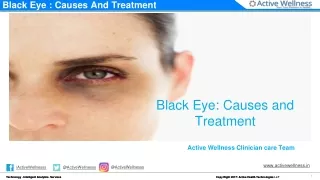 Black Eye : Causes And Treatment