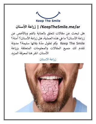 زراعة الأسنان  KeepTheSmile.mear